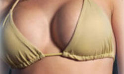 Picture of a woman, happy with her breast lift with implants procedure she had at Top Plastic Surgeons in beautiful San Jose, Costa Rica.  The woman is facing the camera and wearing a mustard yellow bikini top.